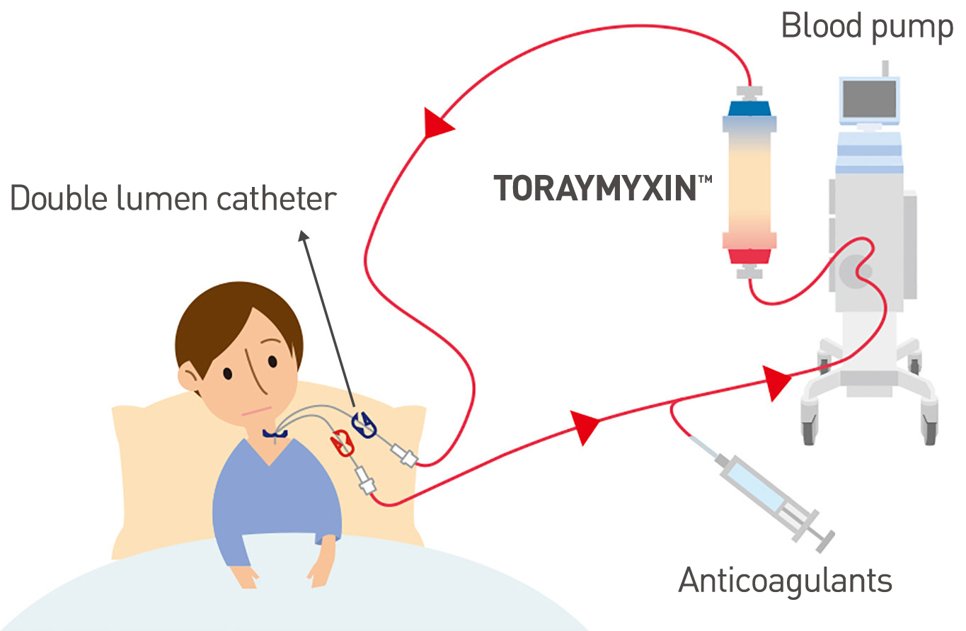 Procedure of TORAYMYXIN™ Treatment